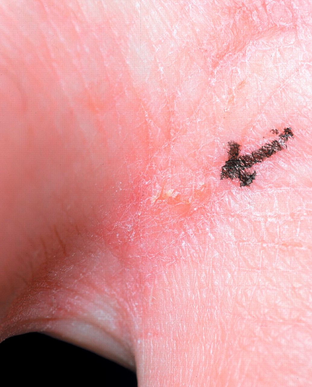 Scabies Burrows Fingers Spanish Academy Of Dermatology And Venereology