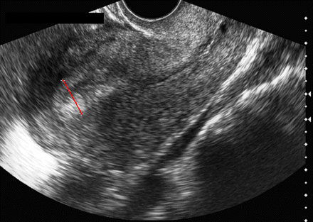 Imaging investigation of postmenopausal bleeding | The BMJ