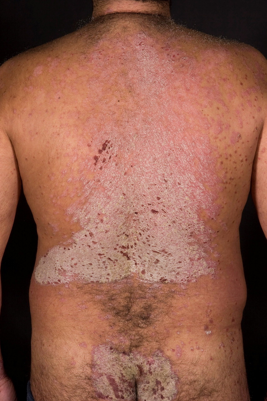 A 41 Year Old Man With An Itchy Rash The BMJ