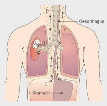 Subcutaneous emphysema | The BMJ