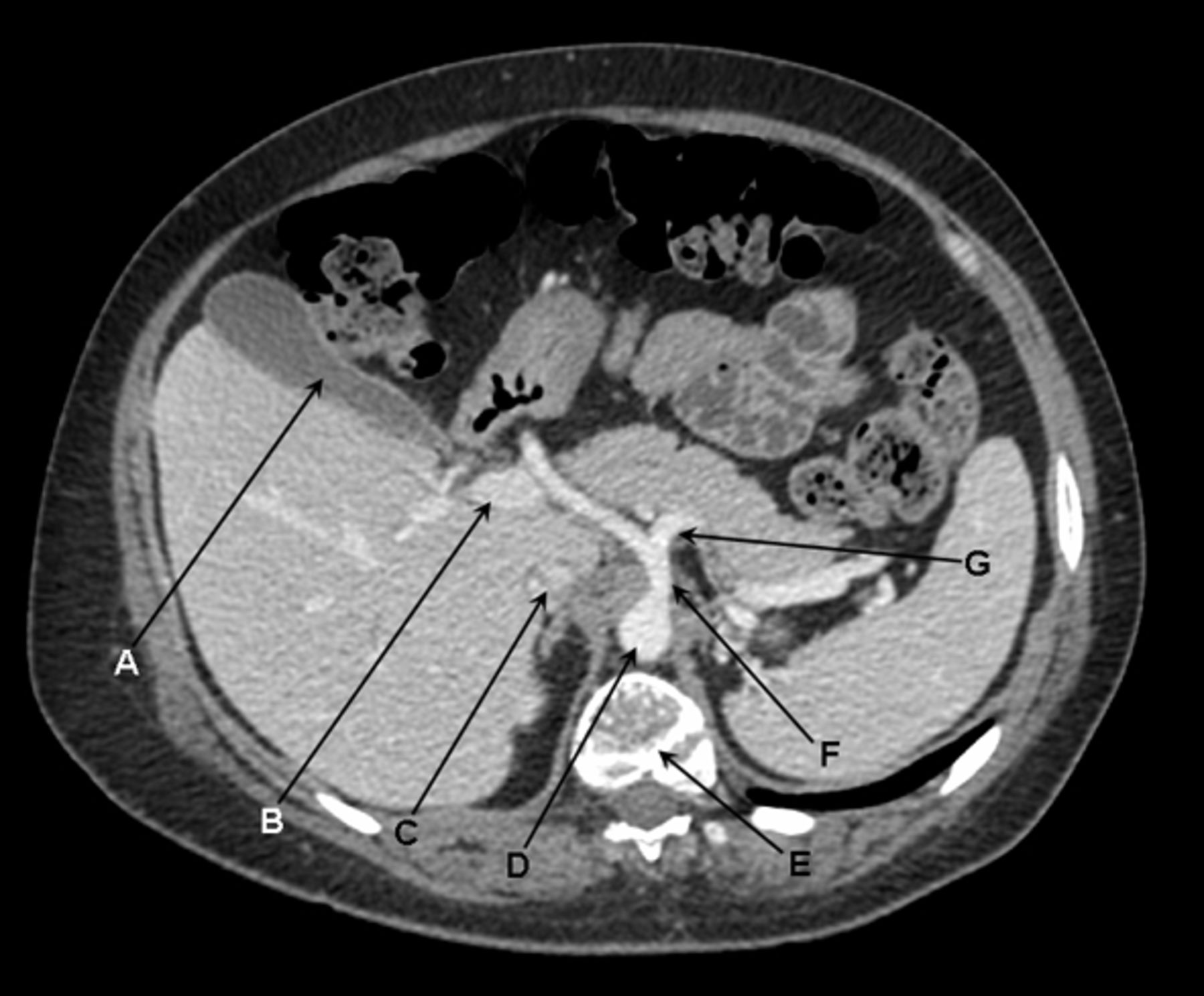 Post contrast axial computed tomogram of the upper abdomen in portal ...