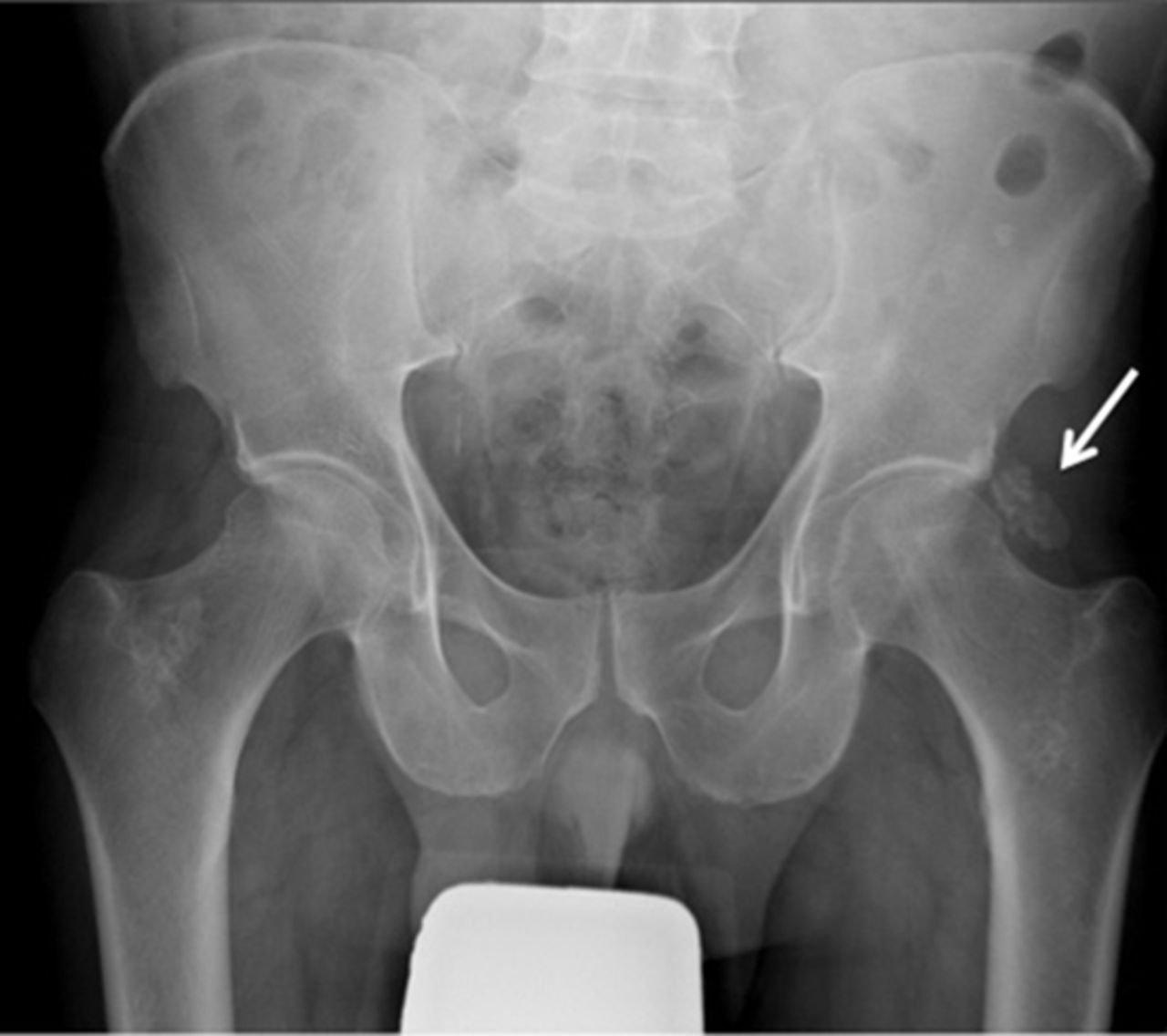 An Unusual Cause Of Hip Pain The BMJ an-unusual-cause-of-hip-pain-the-bmj