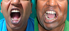 pictures of mouth cancer from smokeless tobacco Figure 3 Oral health consequences use images mouth cancer chewing tobacco