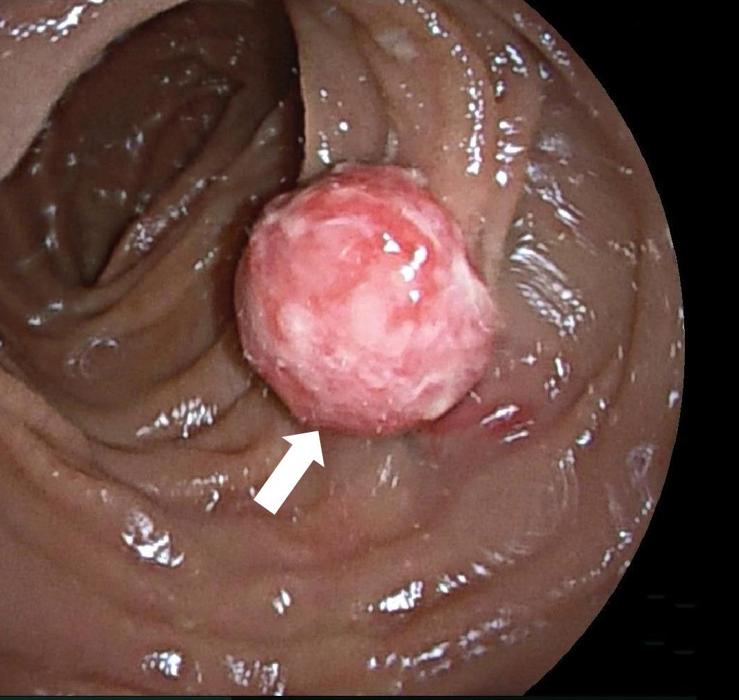 Pyogenic granuloma of the small intestine - Vimarsana News