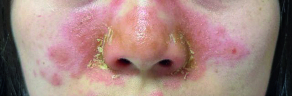 Atypical facial rash in systemic lupus erythematosus | The BMJ